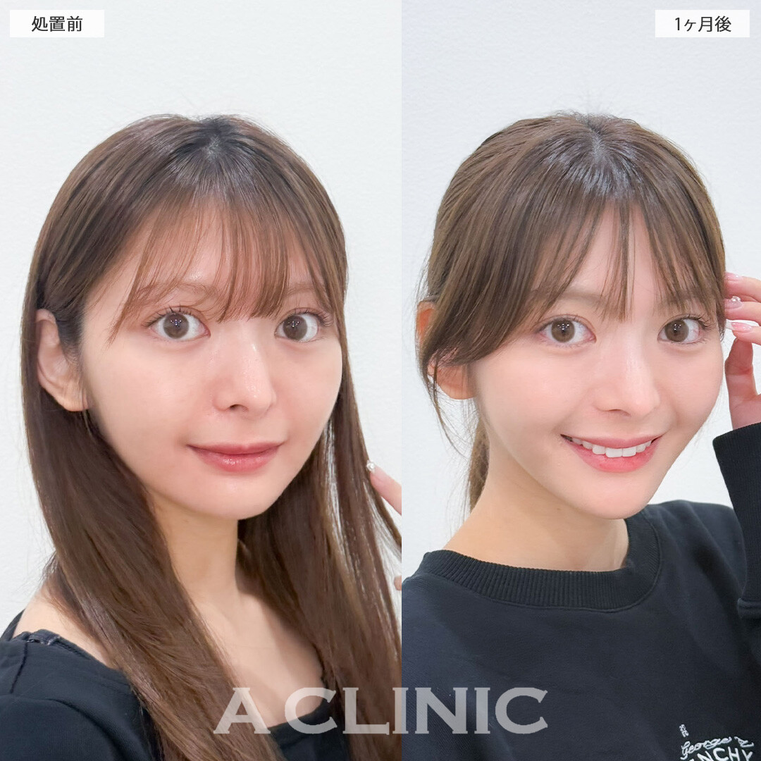 1day小顔脂肪吸引で元々小顔の方も輪郭整えアップデート！こちら処置前と1ヶ月後の症例です(20代女性)