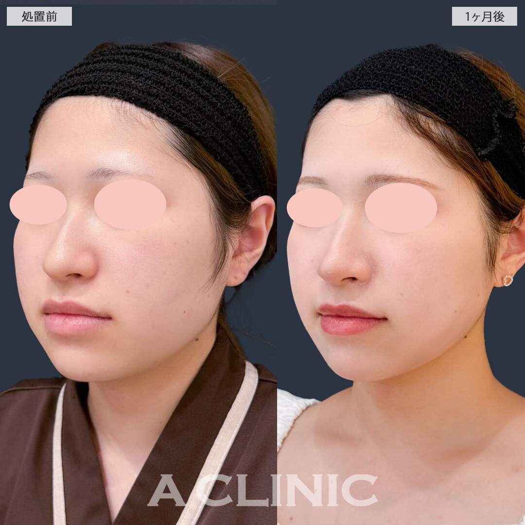 1day小顔脂肪吸引でお顔のボリューム感減らしてスッキリ理想の小顔に！こちら処置前と1ヶ月後の症例です(20代女性)
