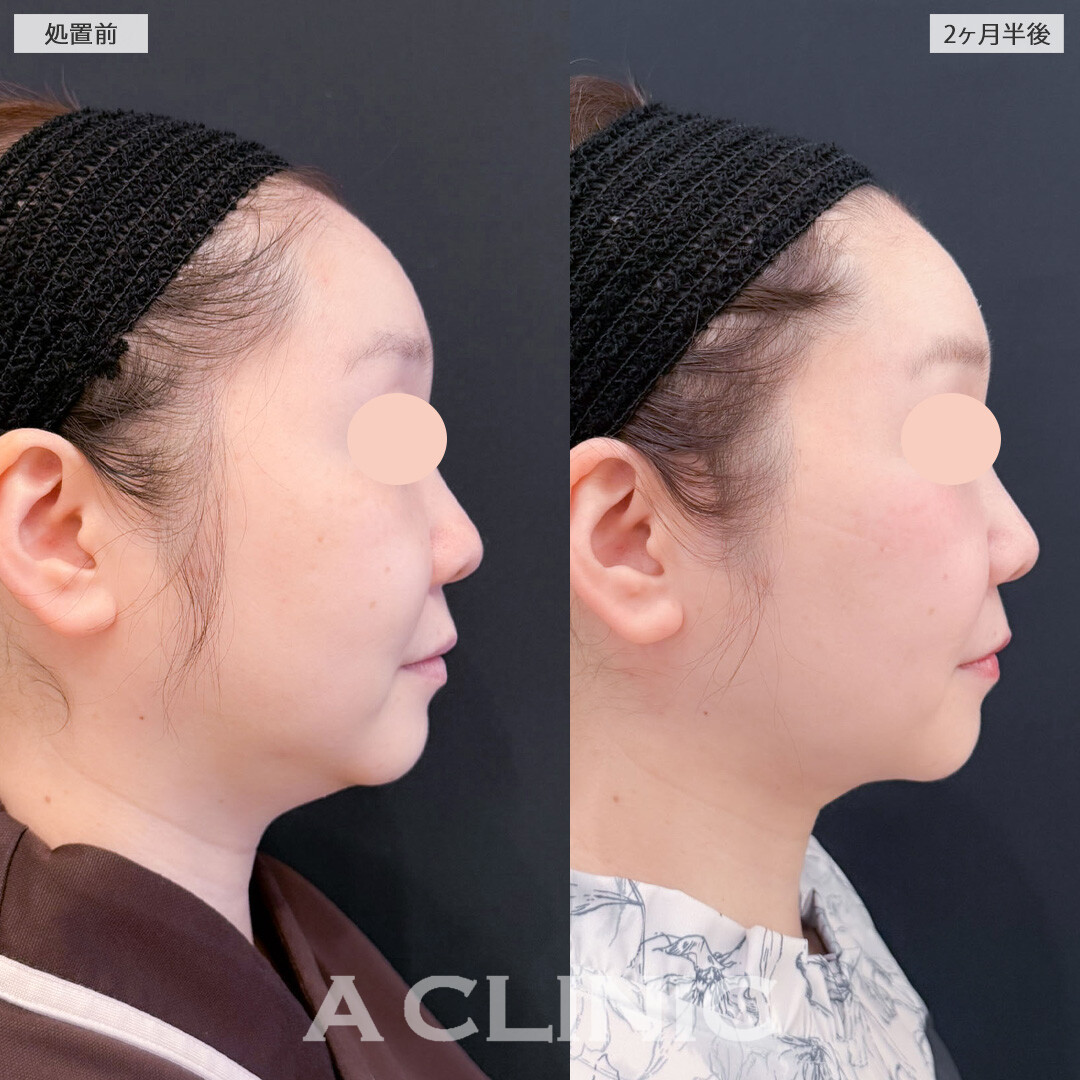 1day小顔脂肪吸引でアゴ下とエラ下をスッキリ！こちら処置前と2ヶ月半後の症例です(30代女性)
