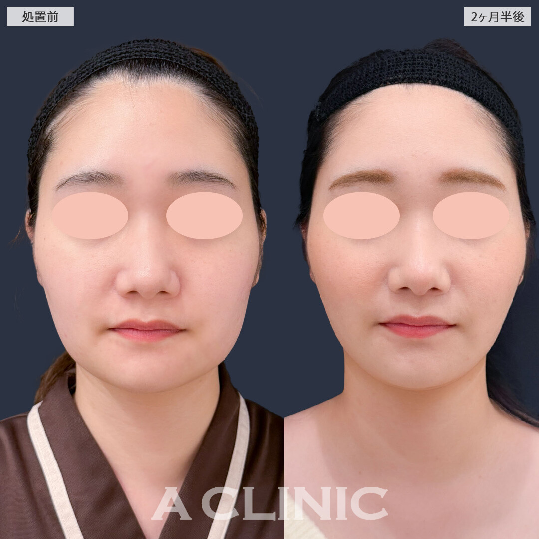 1day小顔脂肪吸引とバッカルファット除去術でホームベース型からたまご型のフェイスラインに！こちら処置前と2ヶ月半後の症例です(20代女性)