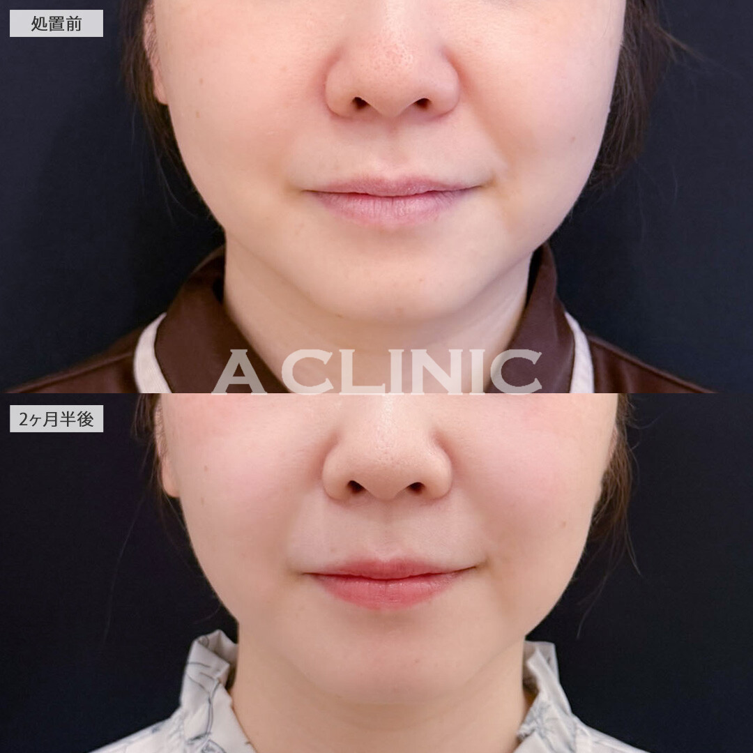 1day小顔脂肪吸引でアゴ下とエラ下をスッキリ！こちら処置前と2ヶ月半後の症例です(30代女性)