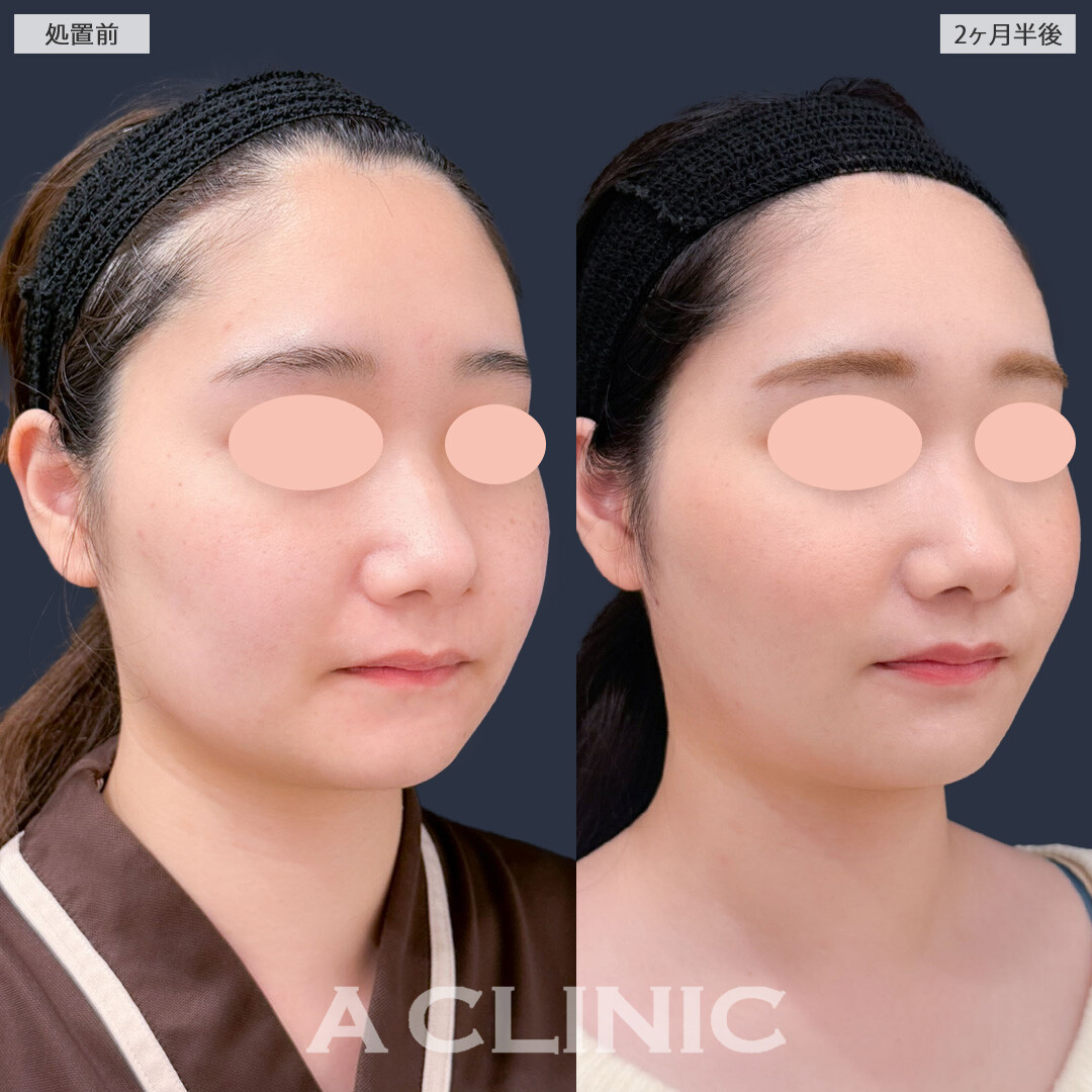 1day小顔脂肪吸引とバッカルファット除去術でホームベース型からたまご型のフェイスラインに！こちら処置前と2ヶ月半後の症例です(20代女性)