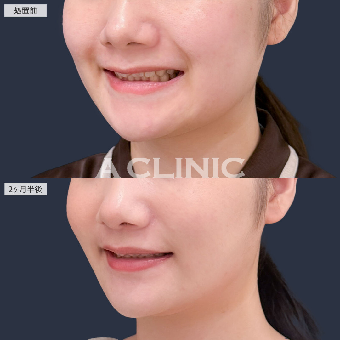 1day小顔脂肪吸引とバッカルファット除去術でホームベース型からたまご型のフェイスラインに！こちら処置前と2ヶ月半後の症例です(20代女性)