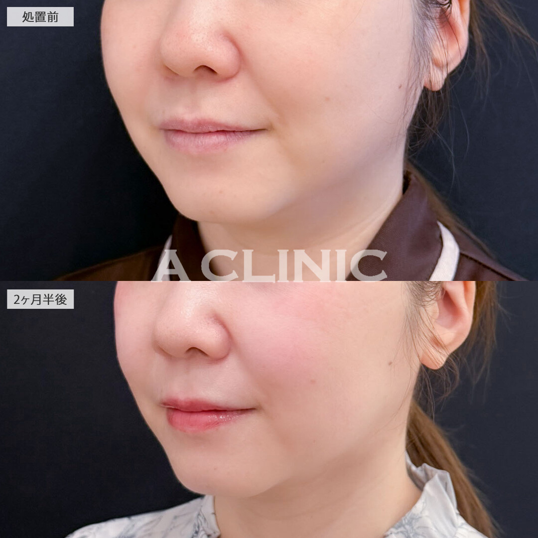 1day小顔脂肪吸引でアゴ下とエラ下をスッキリ！こちら処置前と2ヶ月半後の症例です(30代女性)