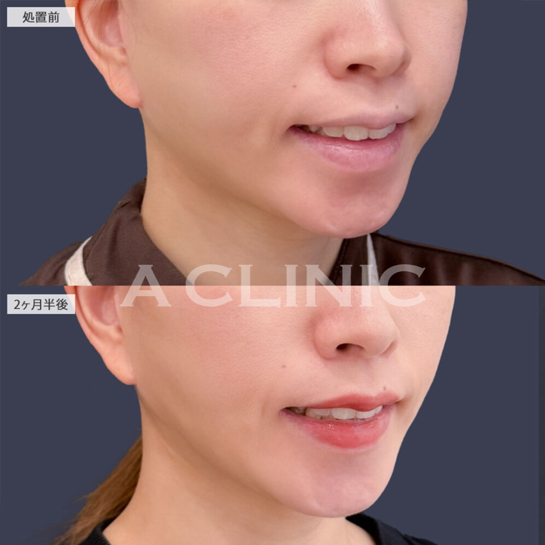 1day小顔脂肪吸引で余分な脂肪なくしてしっかり小顔に！こちら処置前と2ヶ月半後の症例です(30代女性)