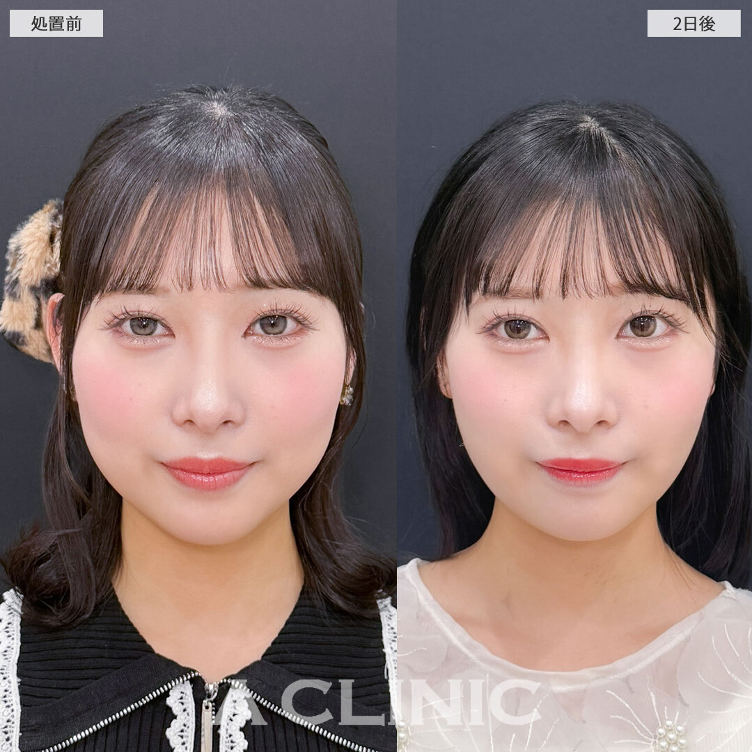 1day小顔脂肪吸引は2日後からすでに効果を感じることが出来ます！こちら処置前と2日後の症例です(20代女性)