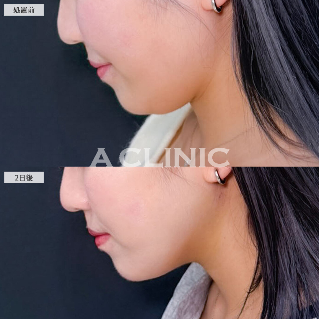 1day小顔脂肪吸引でダウンタイム少なく理想の小顔に！こちら処置前と2日後の症例です(20代女性)