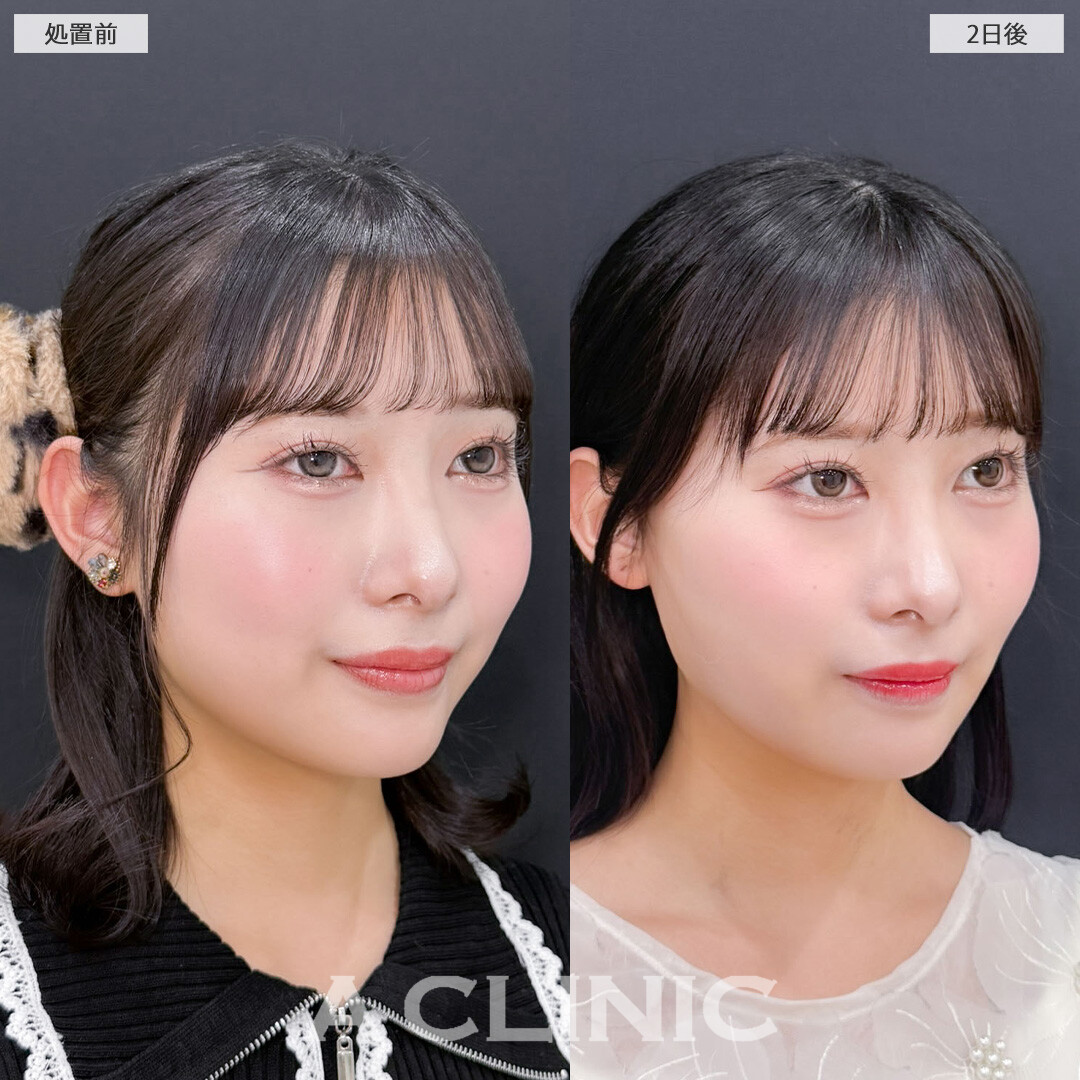 1day小顔脂肪吸引は2日後からすでに効果を感じることが出来ます！こちら処置前と2日後の症例です(20代女性)