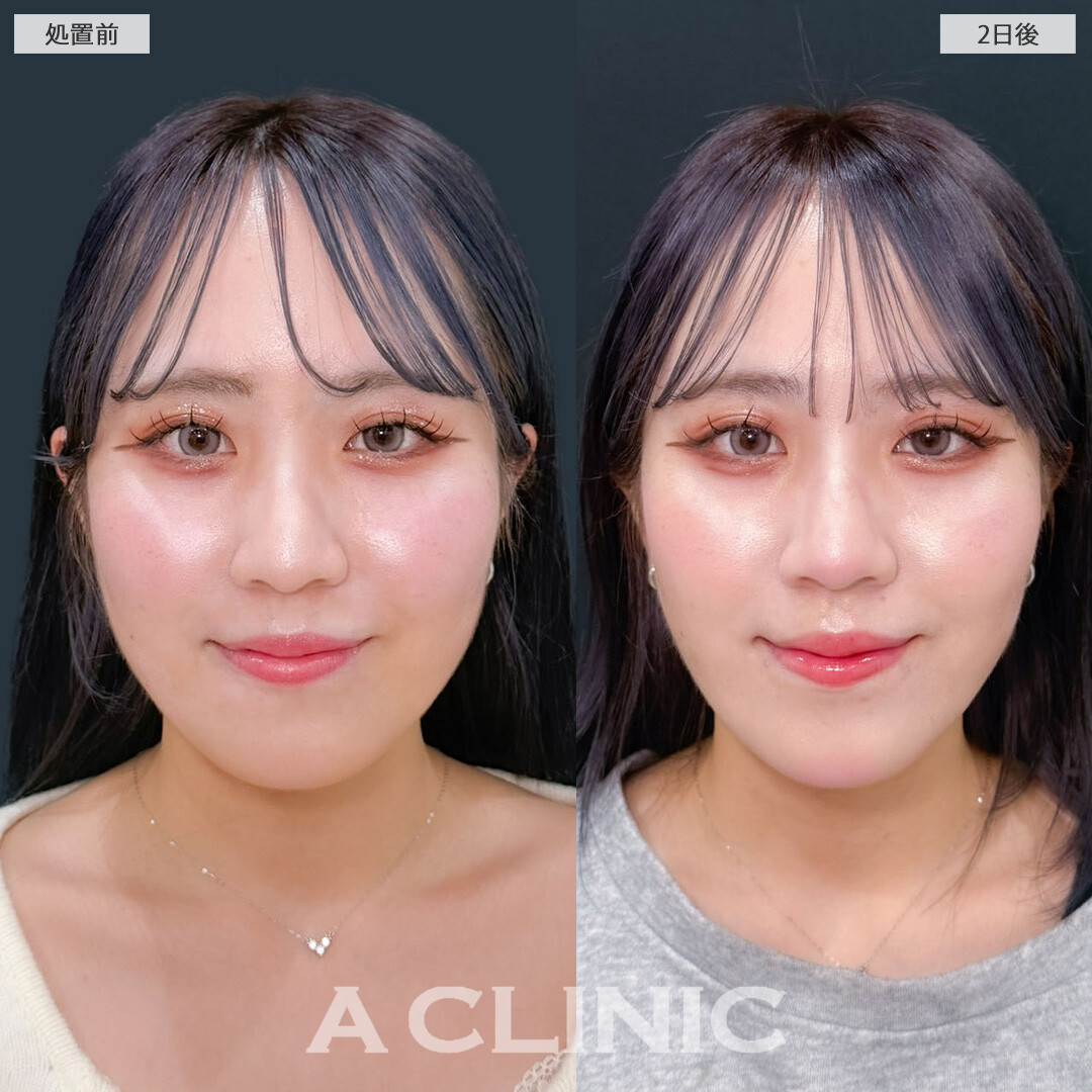 1day小顔脂肪吸引でダウンタイム少なく理想の小顔に！こちら処置前と2日後の症例です(20代女性)
