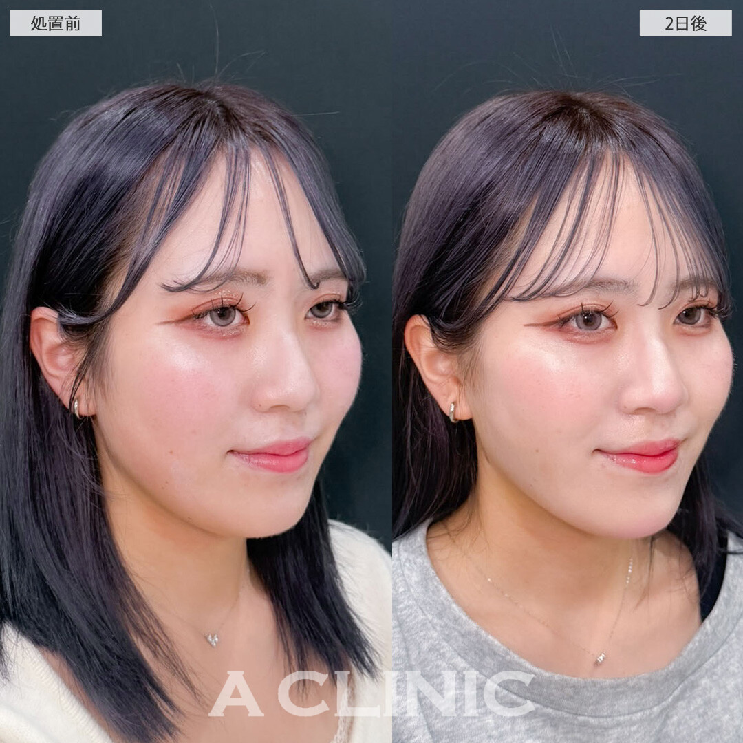 1day小顔脂肪吸引でダウンタイム少なく理想の小顔に！こちら処置前と2日後の症例です(20代女性)