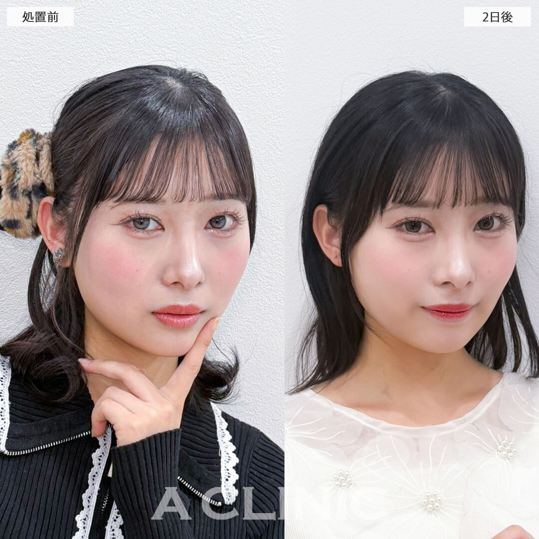 1day小顔脂肪吸引は2日後からすでに効果を感じることが出来ます！こちら処置前と2日後の症例です(20代女性)