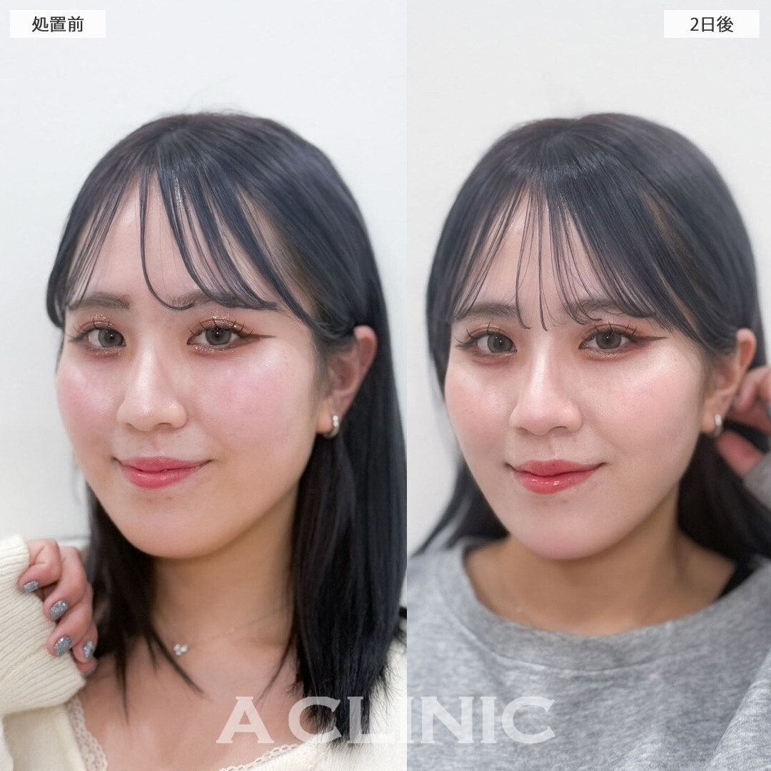 1day小顔脂肪吸引でダウンタイム少なく理想の小顔に！こちら処置前と2日後の症例です(20代女性)