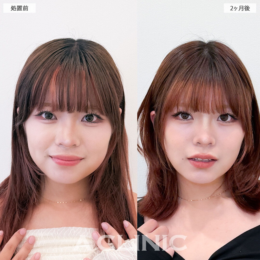 1day小顔脂肪吸引でナチュラルに垢抜け成功しました！こちら処置前と2ヶ月後の症例です(20代女性)