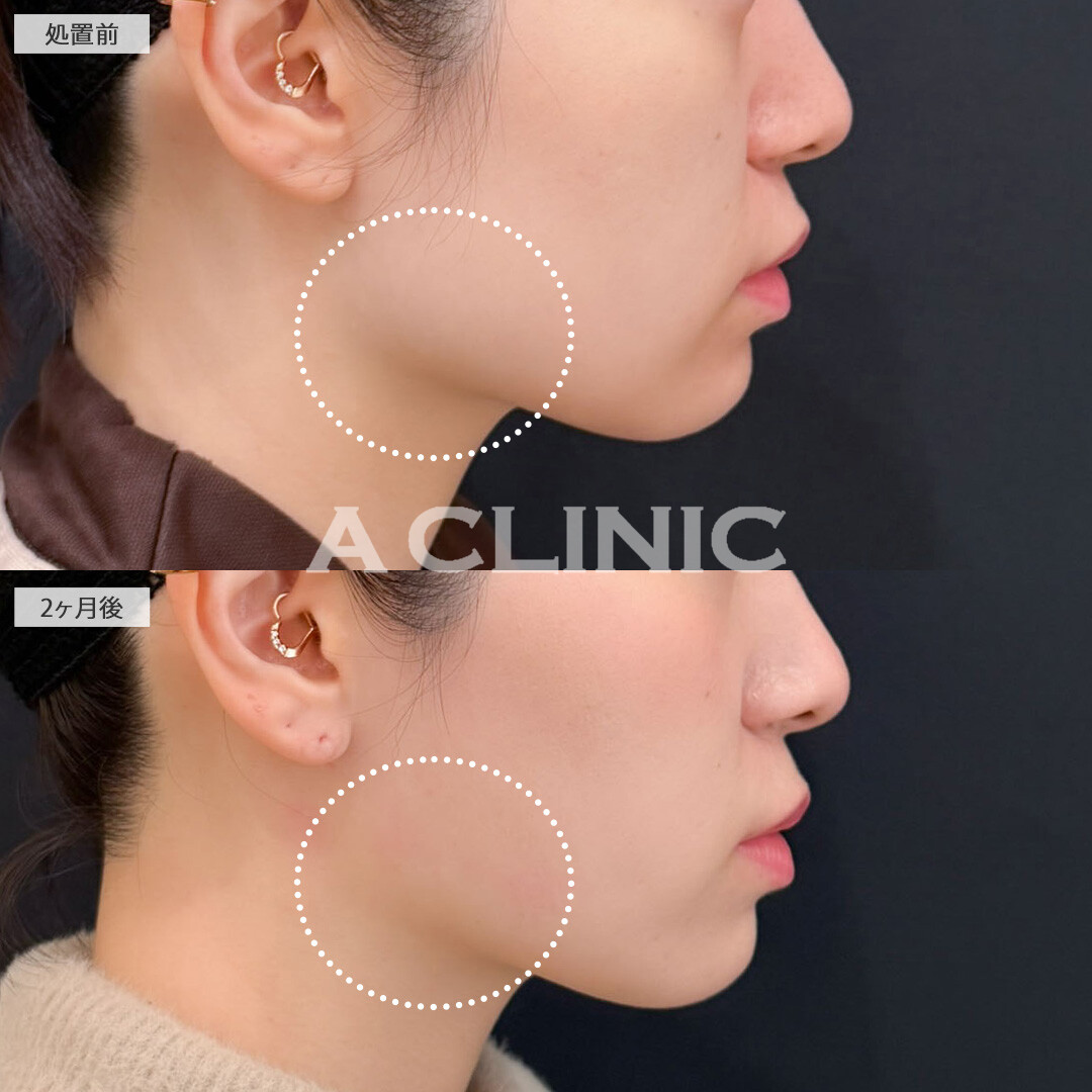 1day小顔脂肪吸引と小顔エラボトックスで顔の余白を減らして理想の小顔に！こちら処置前と2ヶ月後の症例です(30代女性)