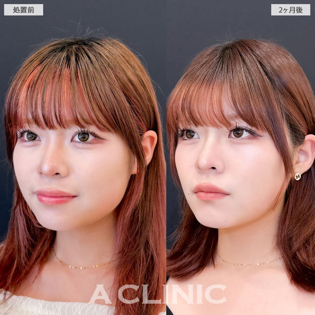 1day小顔脂肪吸引でナチュラルに垢抜け成功しました！こちら処置前と2ヶ月後の症例です(20代女性)