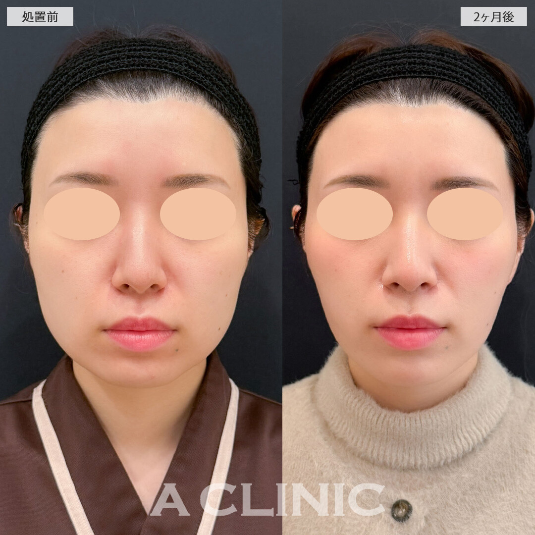 1day小顔脂肪吸引と小顔エラボトックスで顔の余白を減らして理想の小顔に！こちら処置前と2ヶ月後の症例です(30代女性)