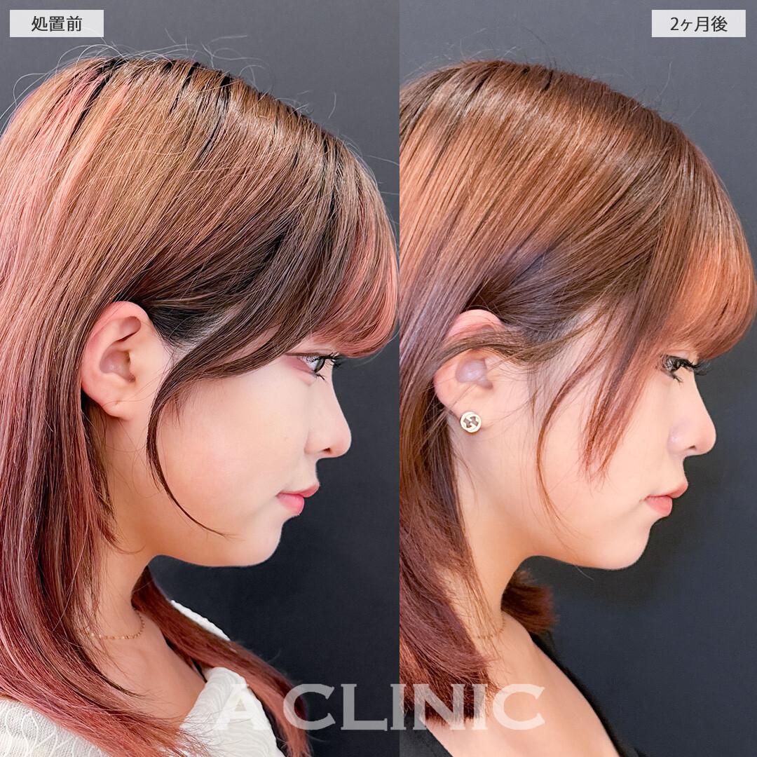 1day小顔脂肪吸引でナチュラルに垢抜け成功しました！こちら処置前と2ヶ月後の症例です(20代女性)