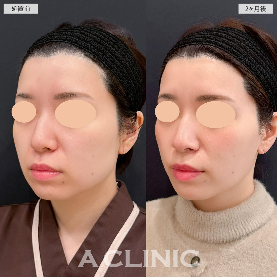 1day小顔脂肪吸引と小顔エラボトックスで顔の余白を減らして理想の小顔に！こちら処置前と2ヶ月後の症例です(30代女性)