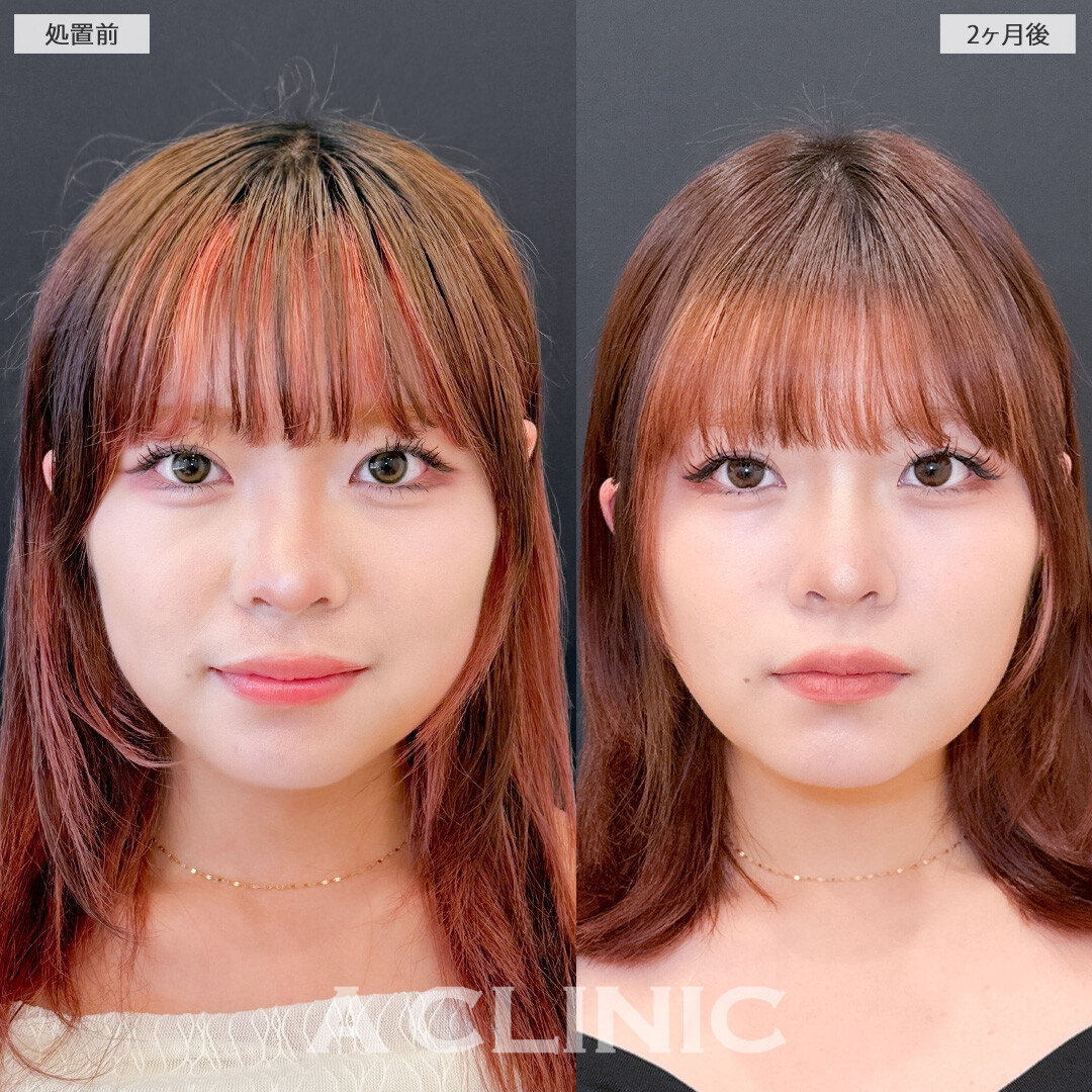 1day小顔脂肪吸引でナチュラルに垢抜け成功しました！こちら処置前と2ヶ月後の症例です(20代女性)