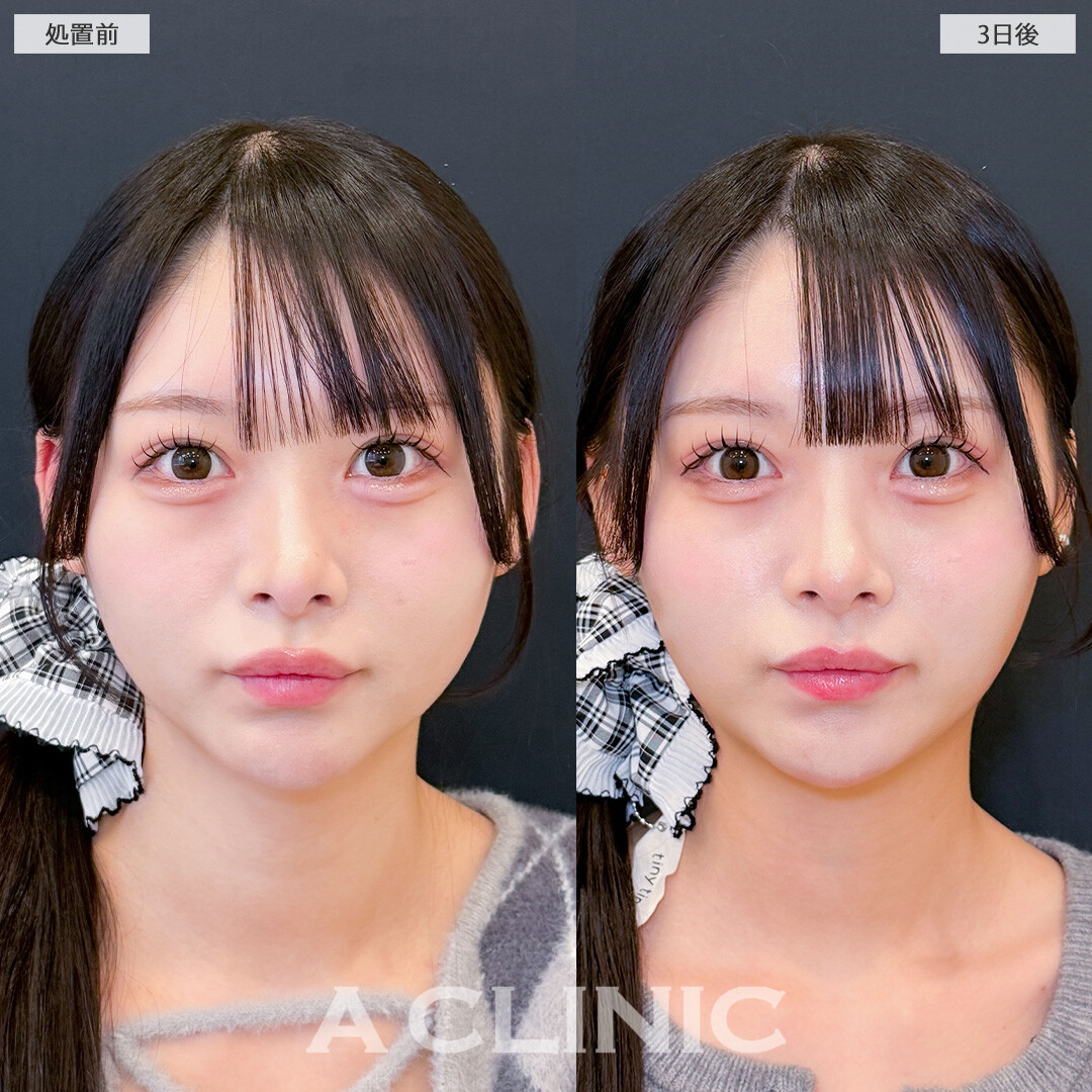 1day小顔脂肪吸引はダウンタイム少なくしっかり小顔になれる施術です！こちら処置前と3日後の症例です(20代女性)