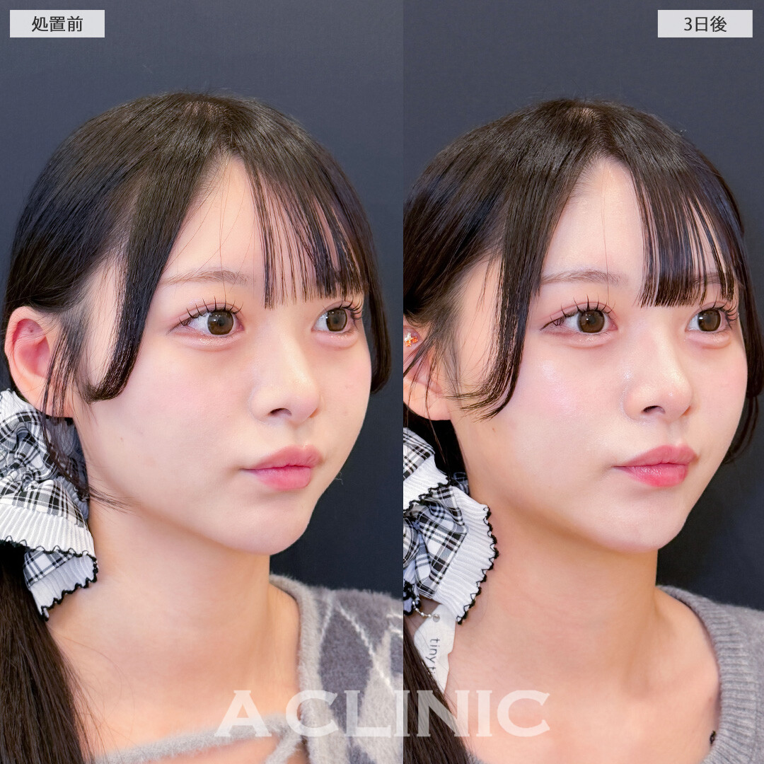 1day小顔脂肪吸引はダウンタイム少なくしっかり小顔になれる施術です！こちら処置前と3日後の症例です(20代女性)