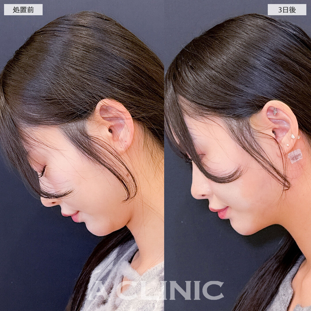 1day小顔脂肪吸引はダウンタイム少なくしっかり小顔になれる施術です！こちら処置前と3日後の症例です(20代女性)