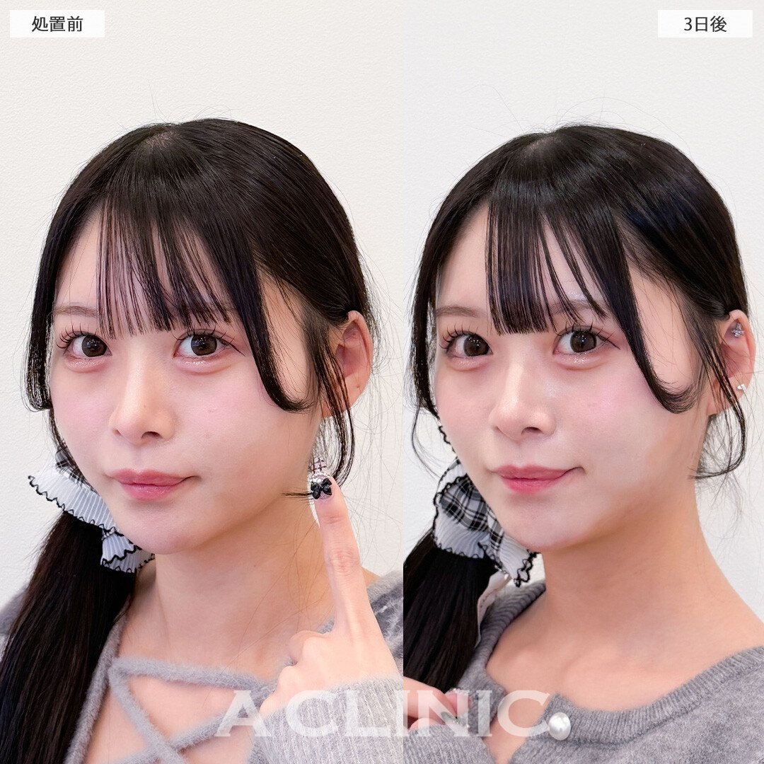 1day小顔脂肪吸引はダウンタイム少なくしっかり小顔になれる施術です！こちら処置前と3日後の症例です(20代女性)
