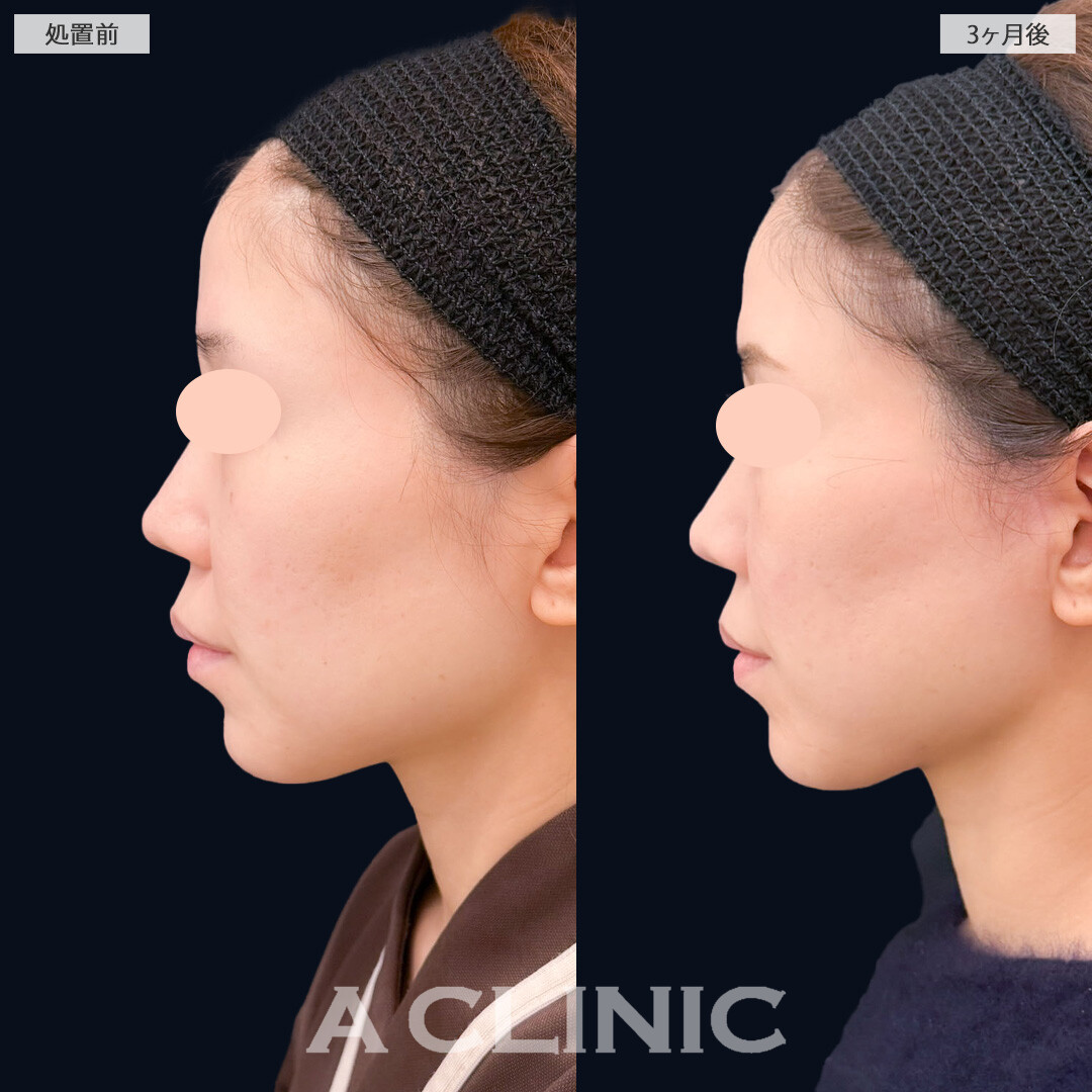 1day小顔脂肪吸引とA式美肌たるみ切開でスッキリ小顔に！こちら処置前と3か月後の症例です(30代女性)