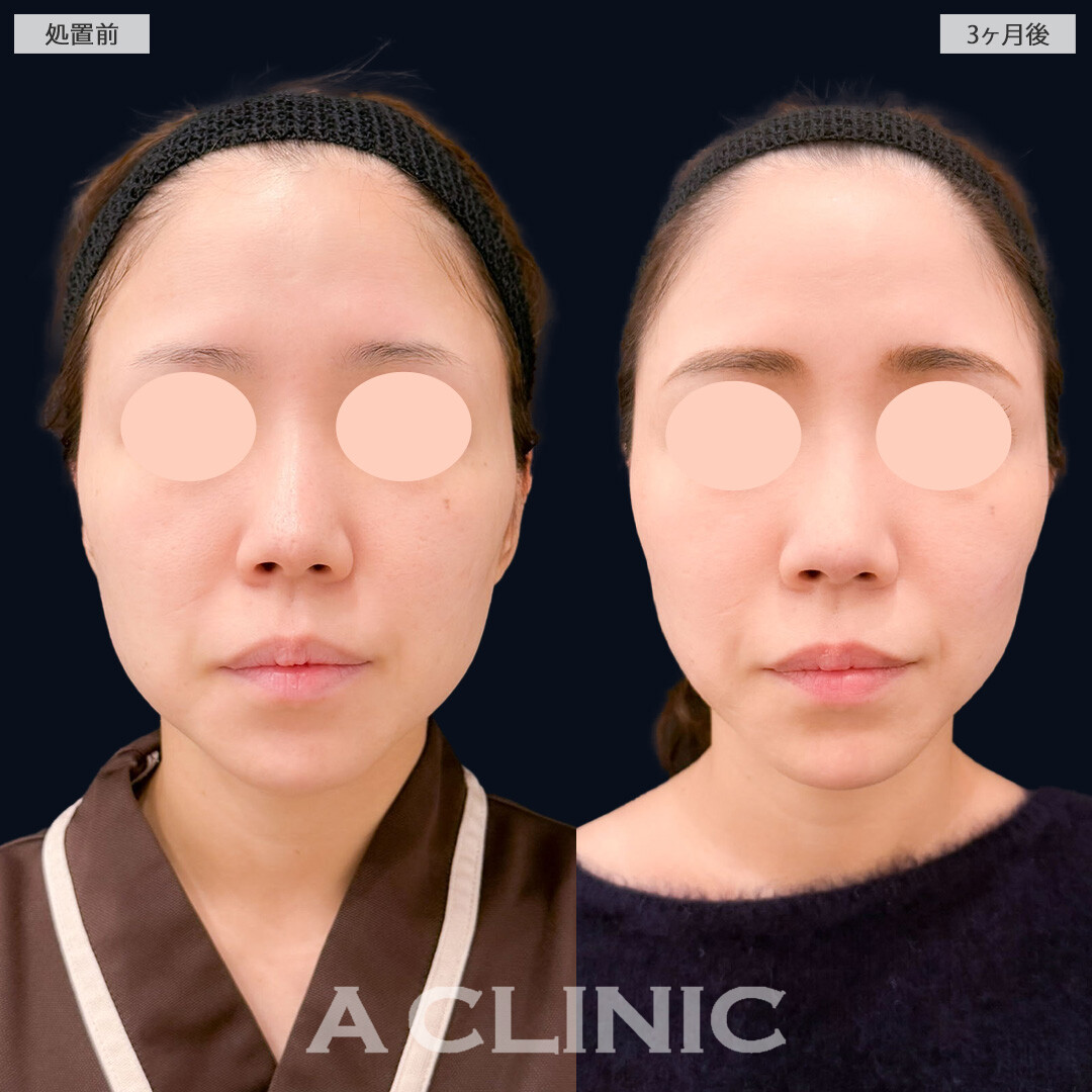 1day小顔脂肪吸引とA式美肌たるみ切開でスッキリ小顔に！こちら処置前と3か月後の症例です(30代女性)
