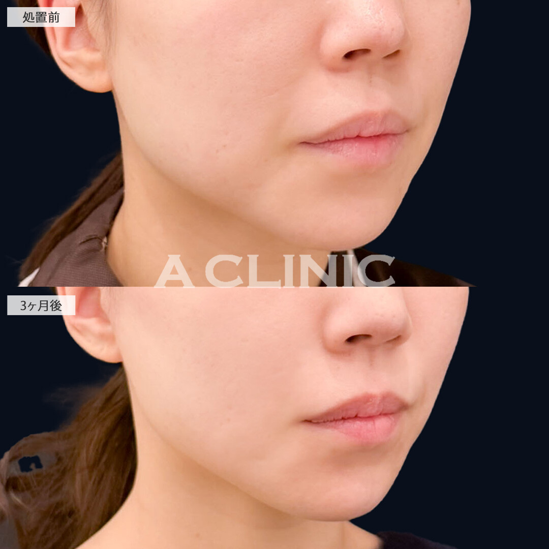 1day小顔脂肪吸引とA式美肌たるみ切開でスッキリ小顔に！こちら処置前と3か月後の症例です(30代女性)