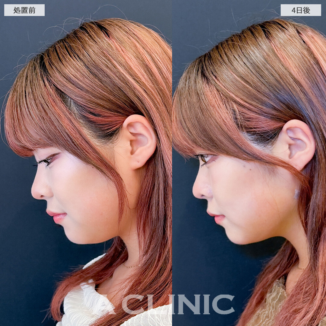 1day小顔脂肪吸引は4日後でもこんなに効果を実感できます！こちら処置前と4日後の症例です(20代女性)