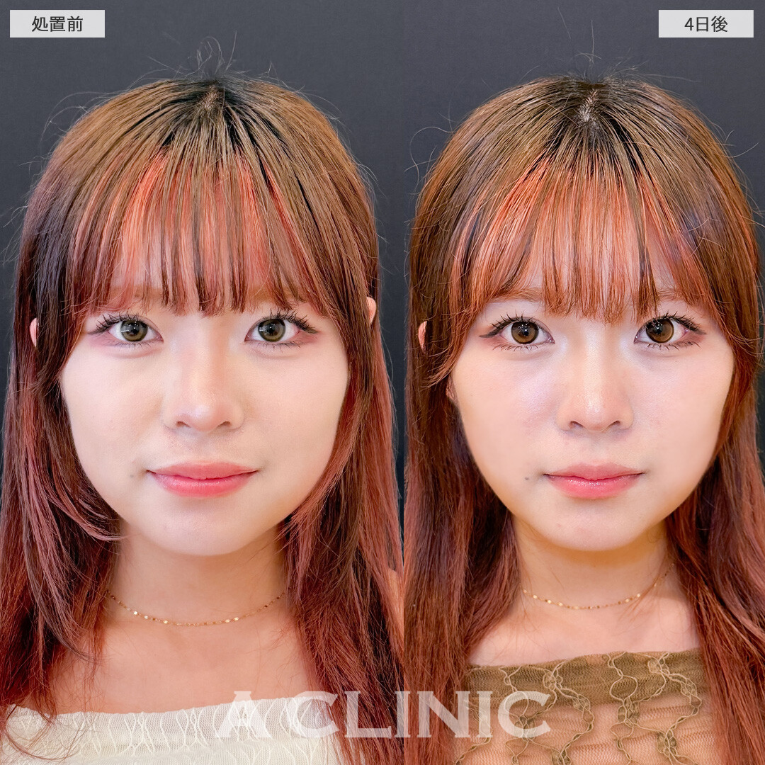 1day小顔脂肪吸引は4日後でもこんなに効果を実感できます！こちら処置前と4日後の症例です(20代女性)