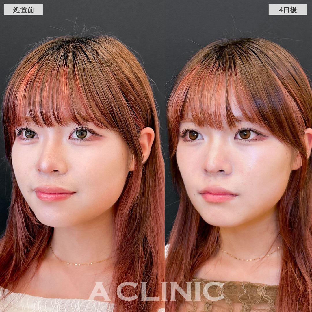 1day小顔脂肪吸引は4日後でもこんなに効果を実感できます！こちら処置前と4日後の症例です(20代女性)