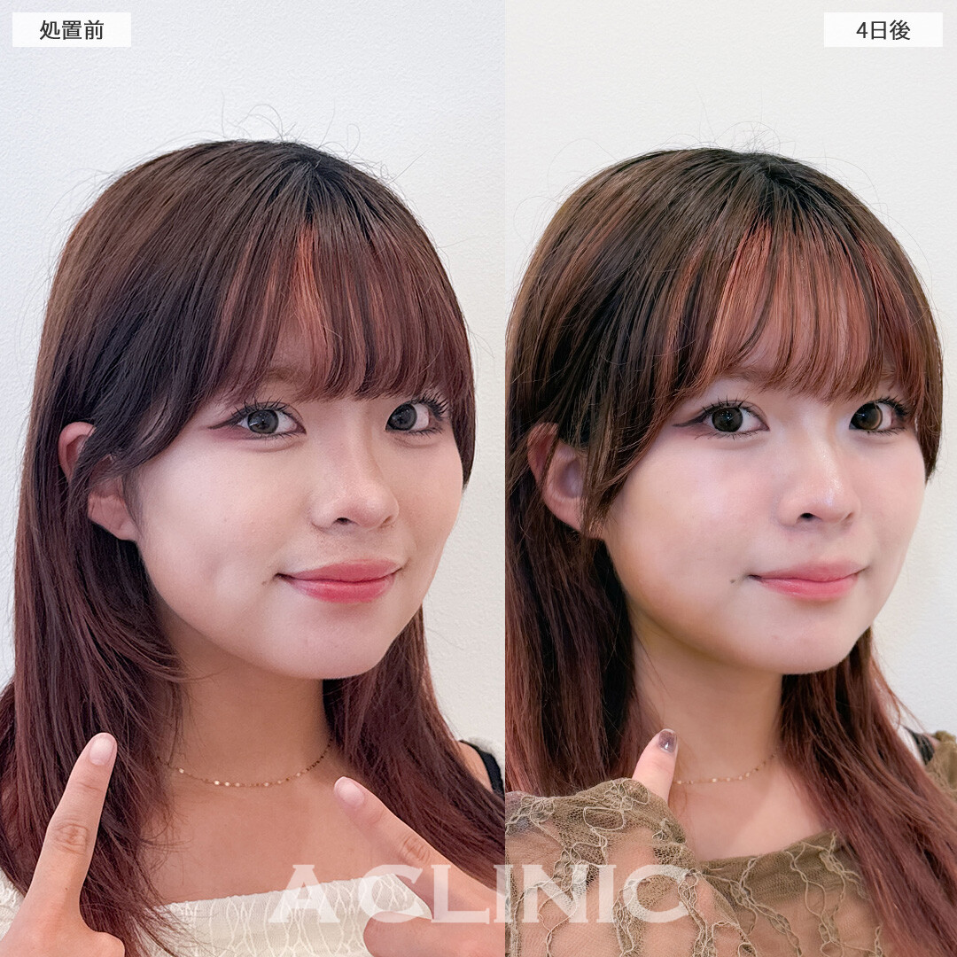 1day小顔脂肪吸引は4日後でもこんなに効果を実感できます！こちら処置前と4日後の症例です(20代女性)