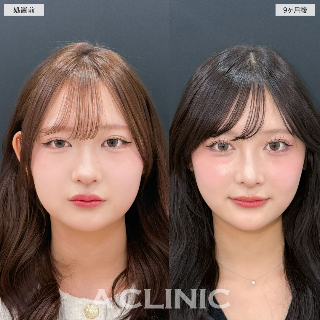 1day小顔脂肪吸引とバッカルファット除去術で丸顔っぽさを解消し小顔美人に！こちら処置前と9か月後の症例です(10代女性)