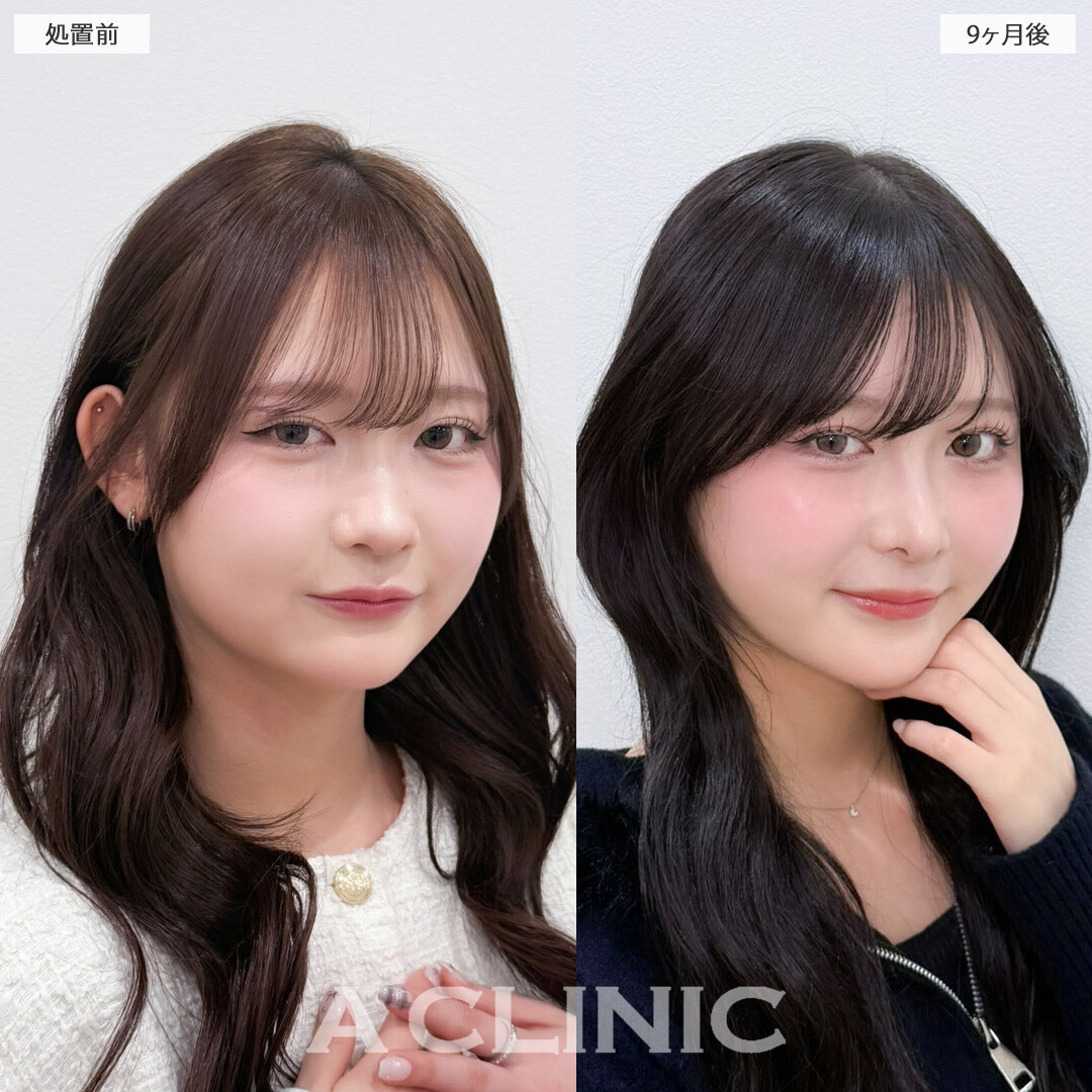 1day小顔脂肪吸引とバッカルファット除去術で丸顔っぽさを解消し小顔美人に！こちら処置前と9か月後の症例です(10代女性)