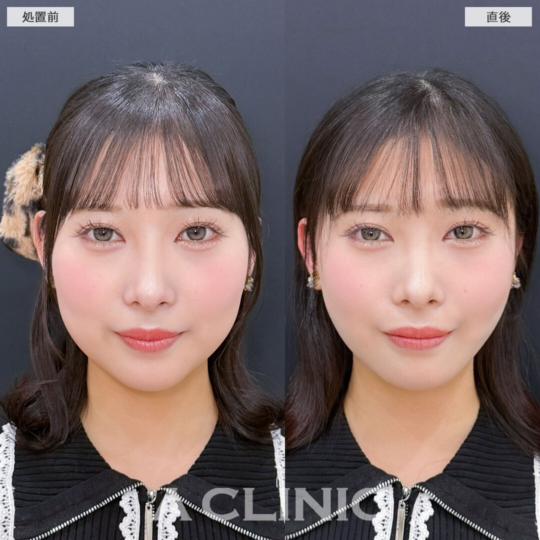 1day小顔脂肪吸引で自然な丸さは残しつつ直後からフェイスラインがスッキリ！こちら処置前と直後の症例です(20代女性)