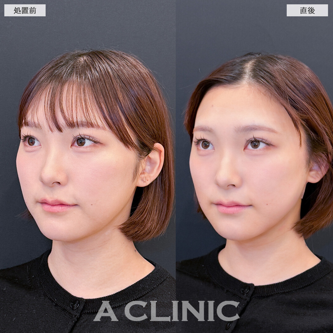 1day小顔脂肪吸引はダウンタイム少なく理想の小顔になれる施術です！こちら処置前と直後の症例です(20代女性)