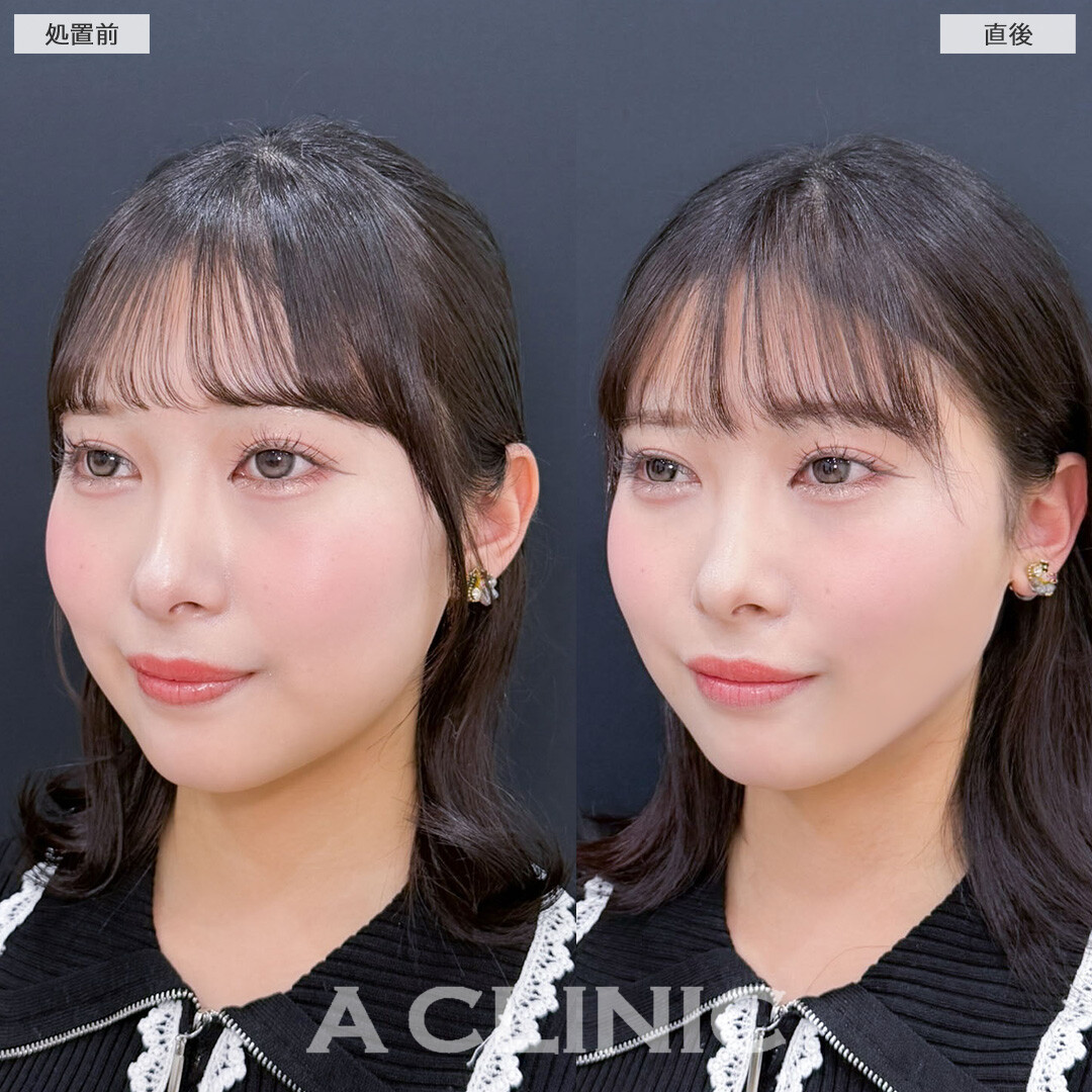 1day小顔脂肪吸引で自然な丸さは残しつつ直後からフェイスラインがスッキリ！こちら処置前と直後の症例です(20代女性)