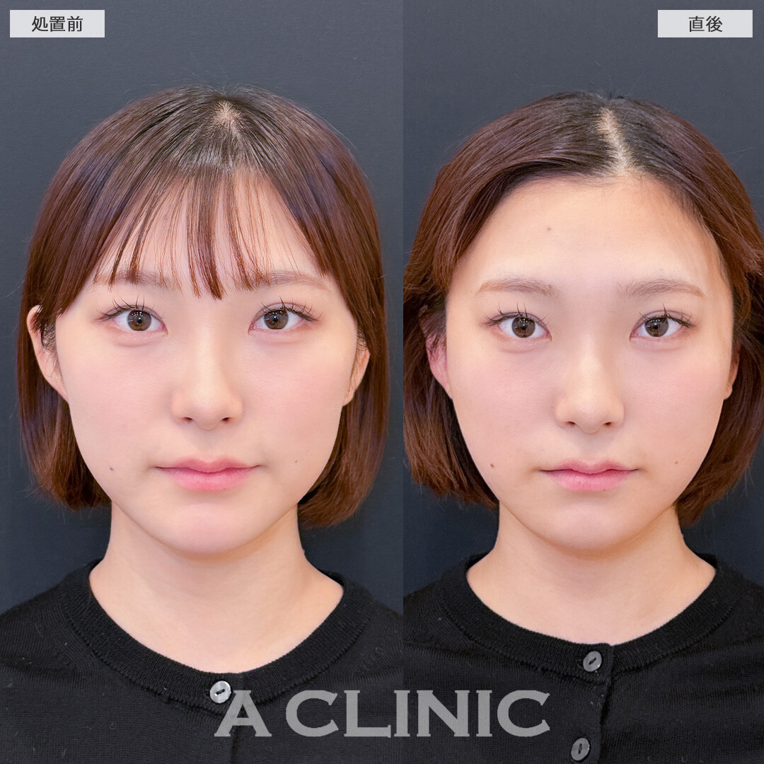 1day小顔脂肪吸引はダウンタイム少なく理想の小顔になれる施術です！こちら処置前と直後の症例です(20代女性)