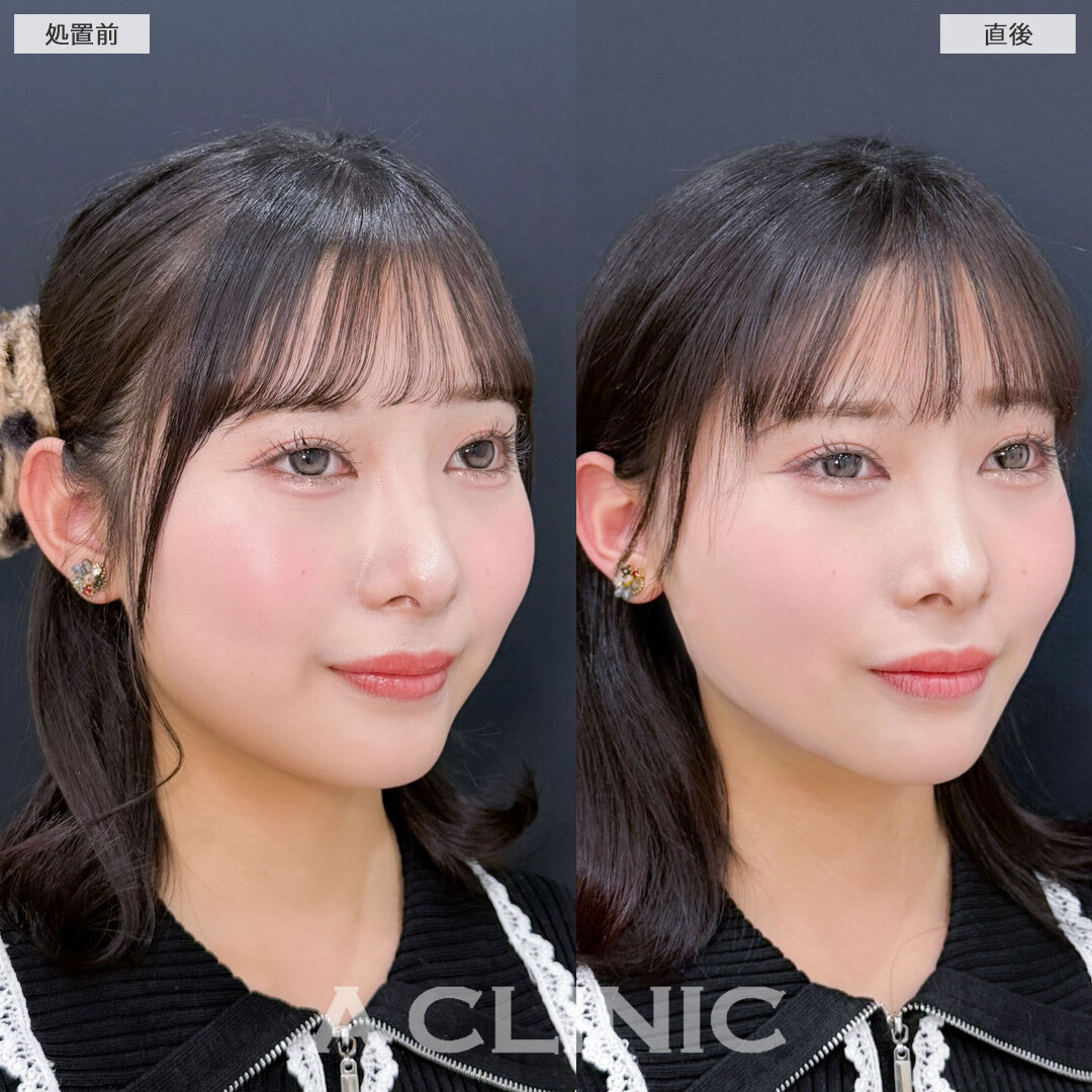 1day小顔脂肪吸引で自然な丸さは残しつつ直後からフェイスラインがスッキリ！こちら処置前と直後の症例です(20代女性)