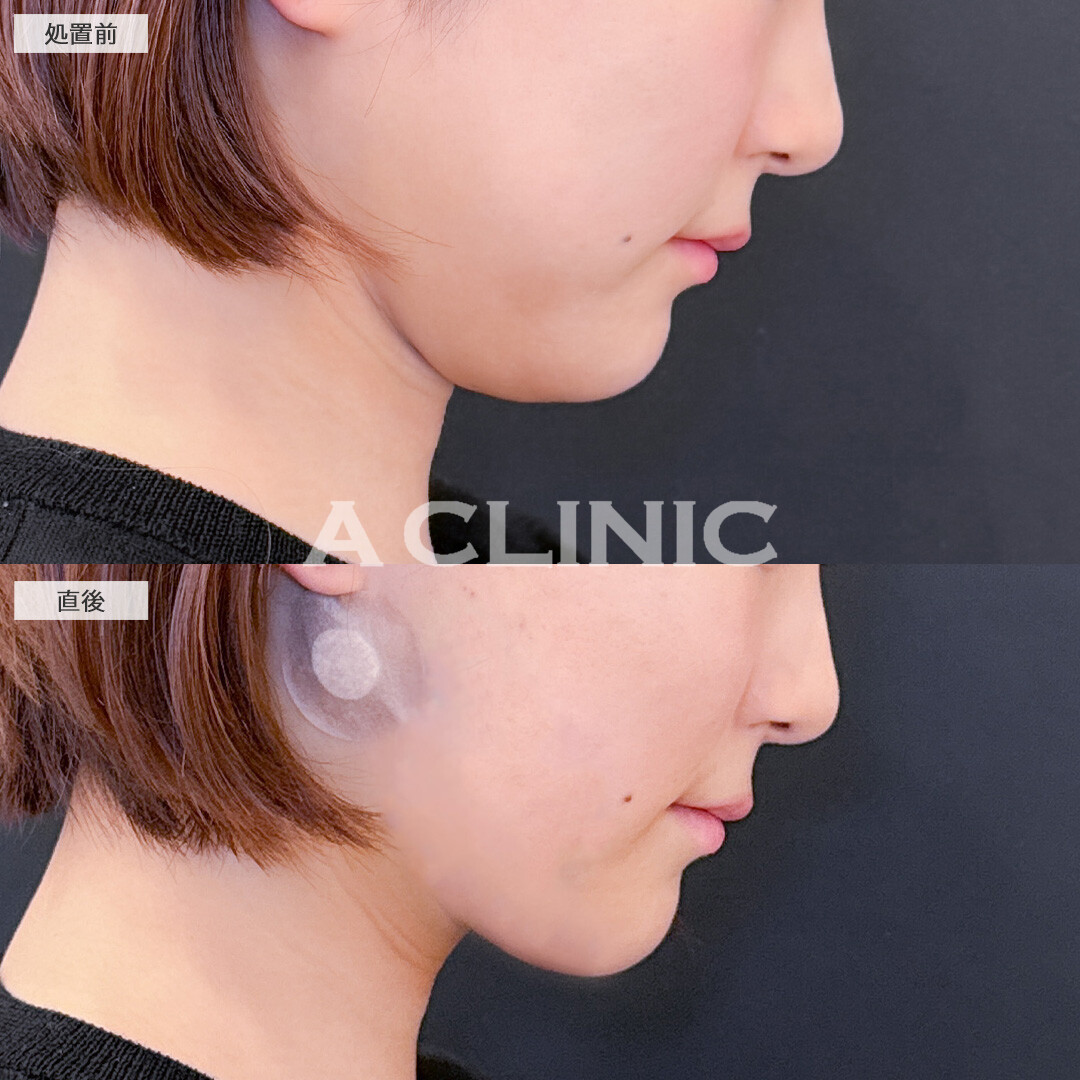 1day小顔脂肪吸引はダウンタイム少なく理想の小顔になれる施術です！こちら処置前と直後の症例です(20代女性)