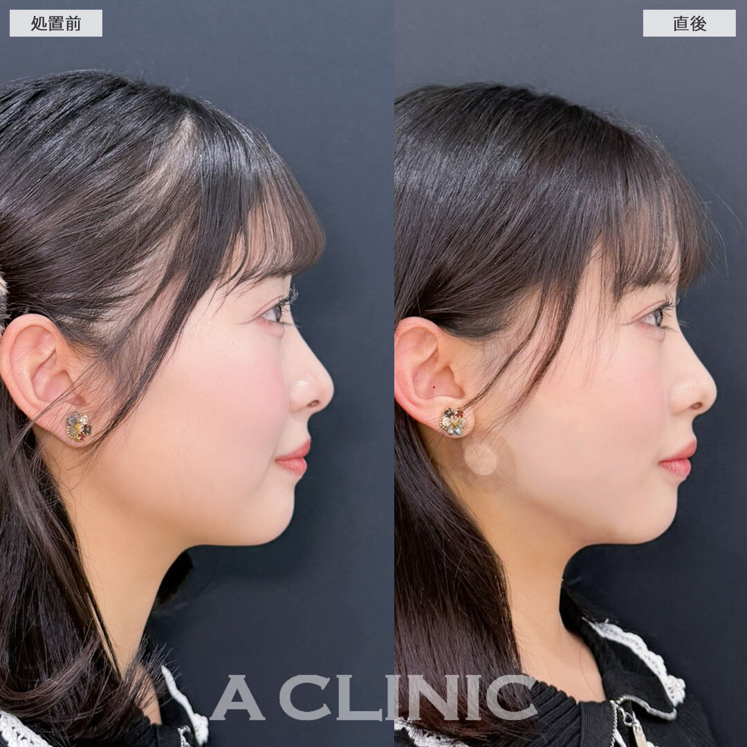 1day小顔脂肪吸引で自然な丸さは残しつつ直後からフェイスラインがスッキリ！こちら処置前と直後の症例です(20代女性)