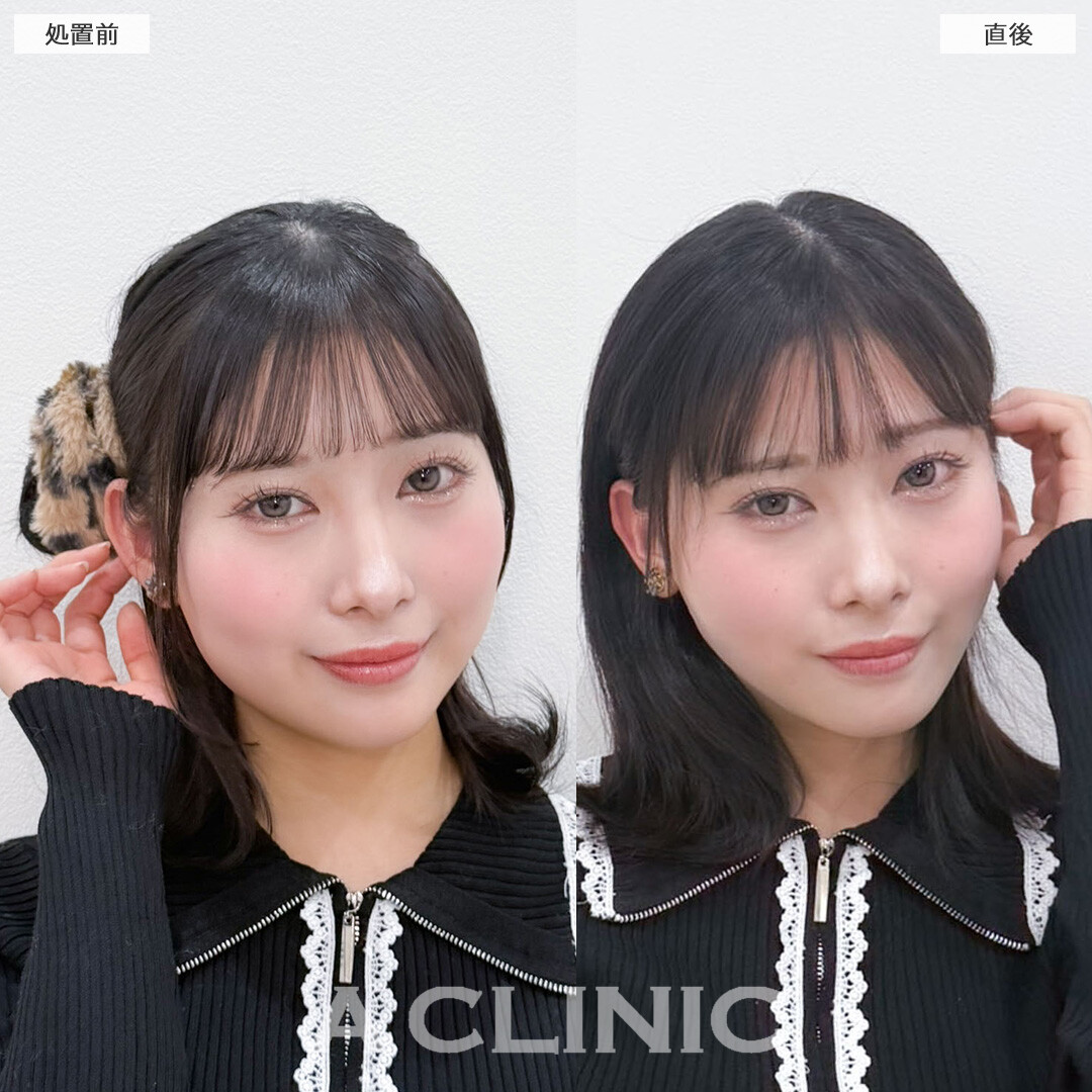 1day小顔脂肪吸引で自然な丸さは残しつつ直後からフェイスラインがスッキリ！こちら処置前と直後の症例です(20代女性)