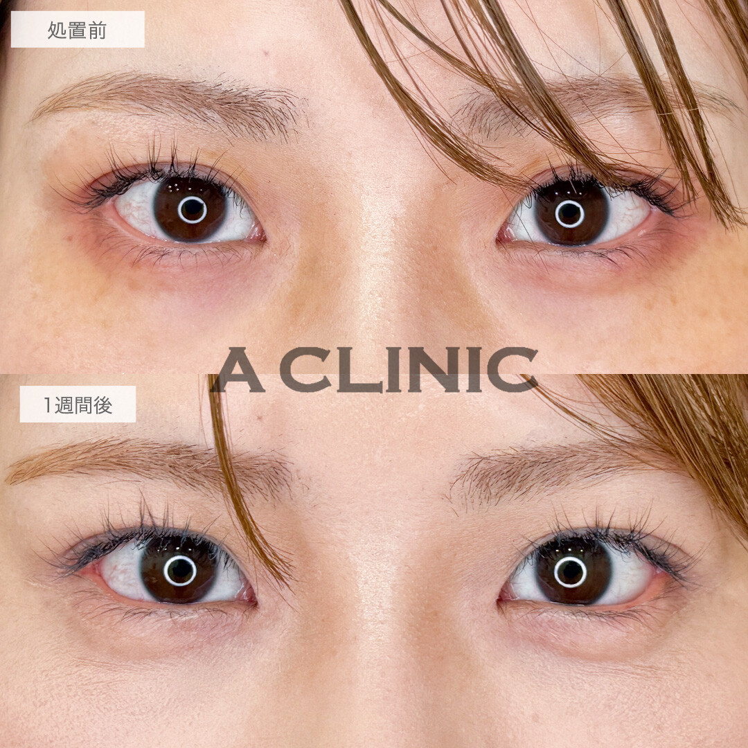 たれ目になって優しい印象のお目元になりました！パーフェクトアイズの処置前と1週間後の症例です(30代女性)