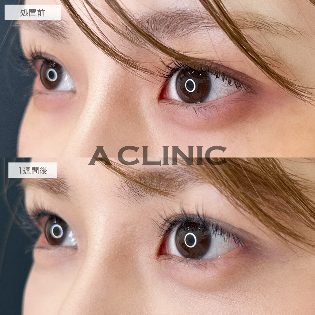 たれ目になって優しい印象のお目元になりました！パーフェクトアイズの処置前と1週間後の症例です(30代女性)
