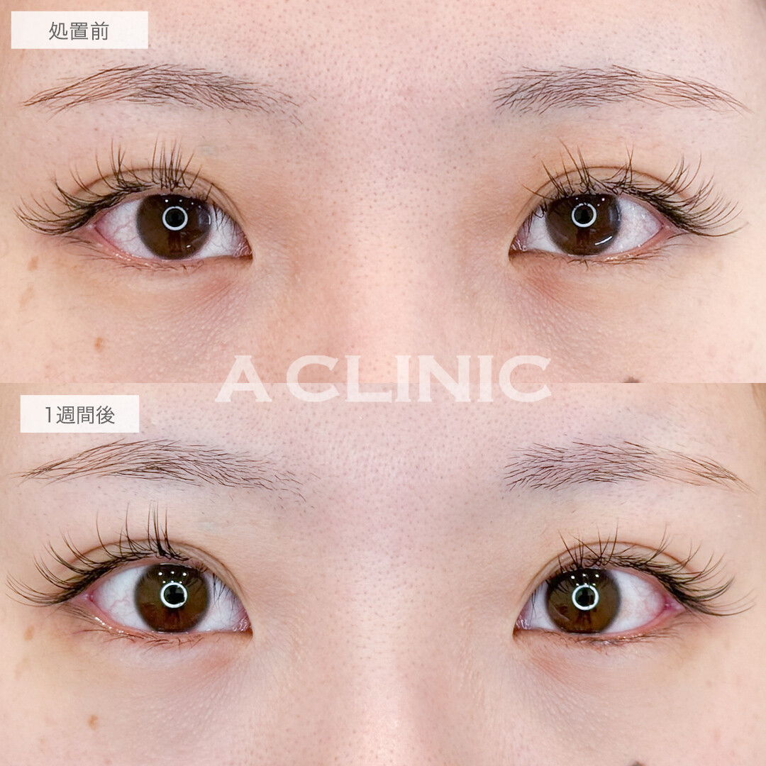 パーフェクトアイズで目の縦幅拡大！処置前と1週間後の症例です(20代女性)