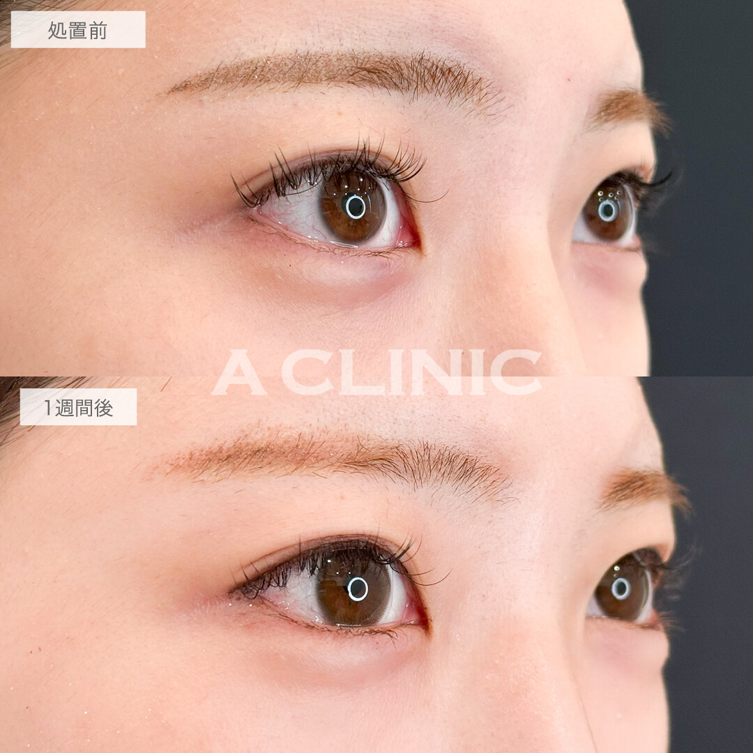 パーフェクトアイズでちゅるんと可愛いタレ目に！処置前と1週間後の症例です(20代症例)