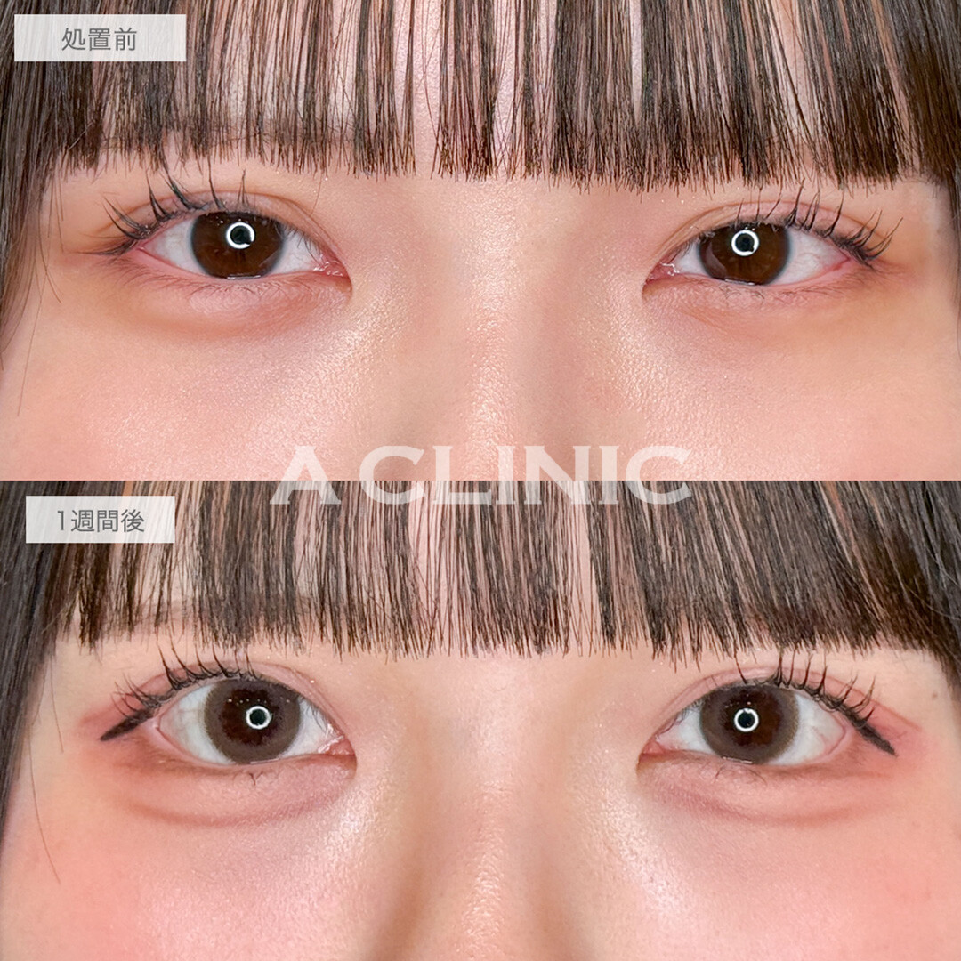 パーフェクトアイズで可愛い印象の丸目に！こちら処置前と1週間後の症例です(20代女性)