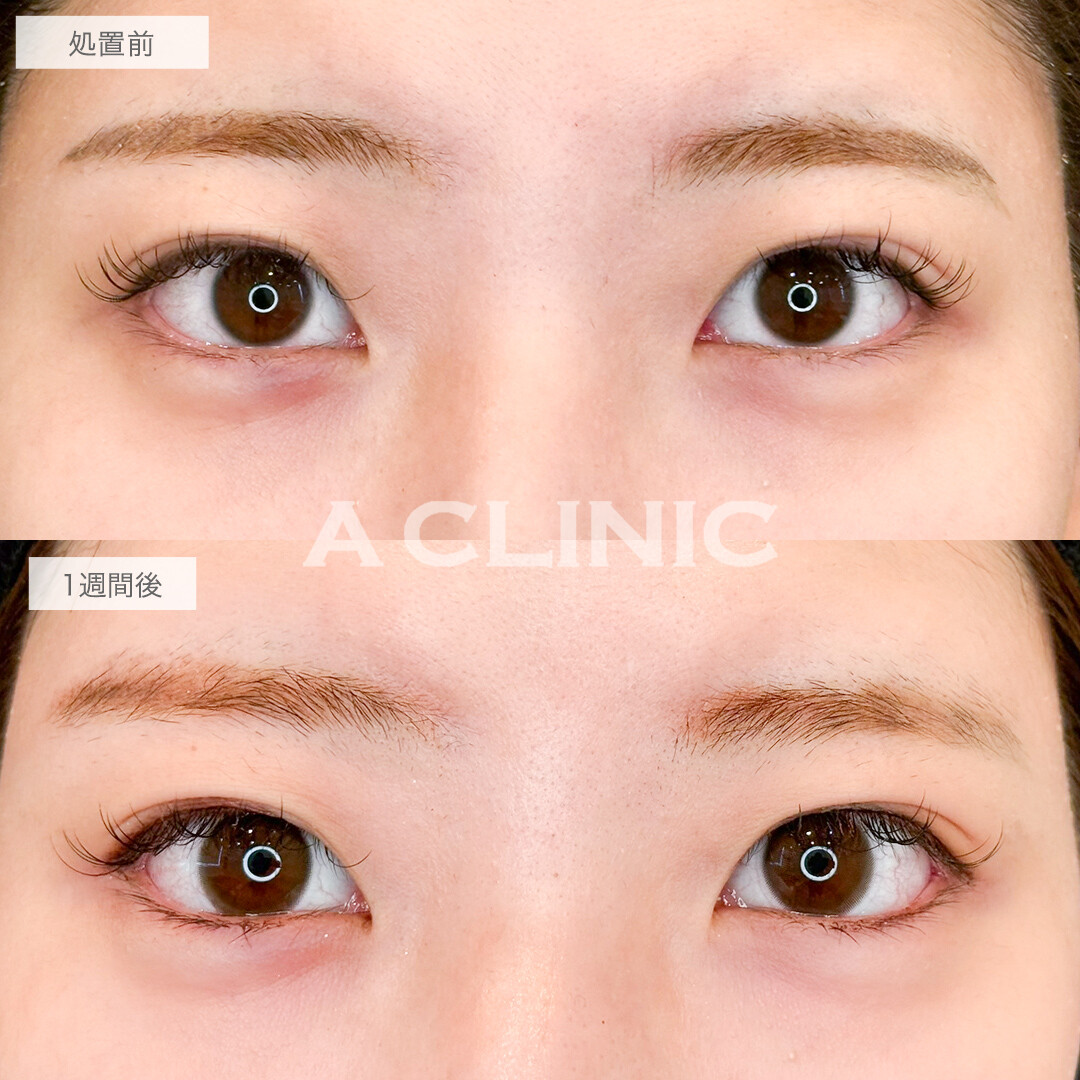 パーフェクトアイズでちゅるんと可愛いタレ目に！処置前と1週間後の症例です(20代症例)